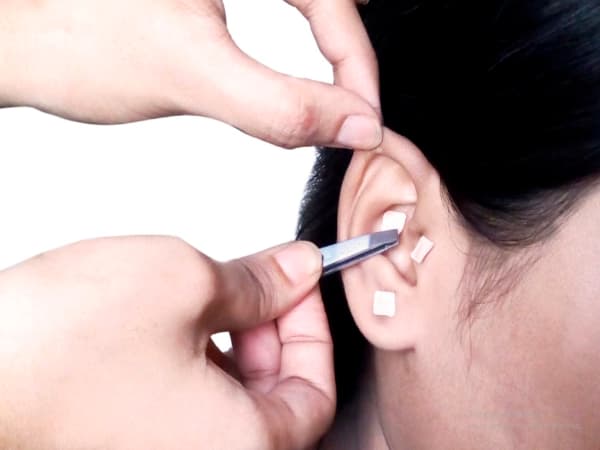 Auriculoterapia