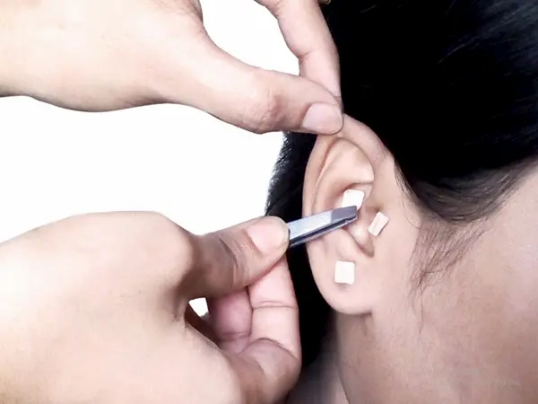 Auriculoterapia