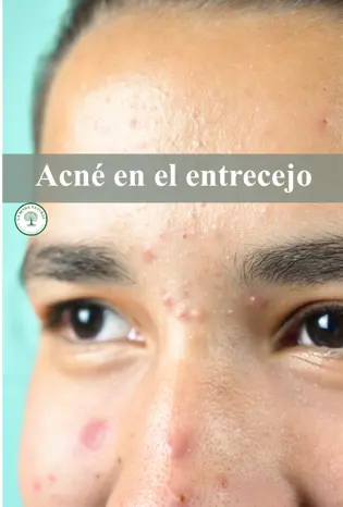 Acné en el entrecejo