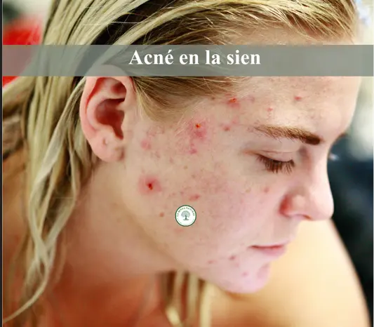 Acné en la sien