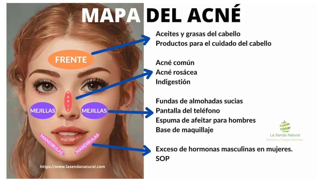 MAPEO DEL ACNE EN LA CARA