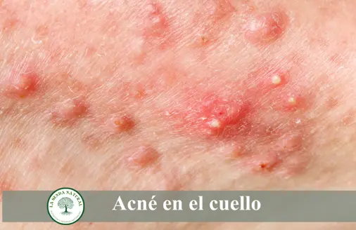acné en el cuello