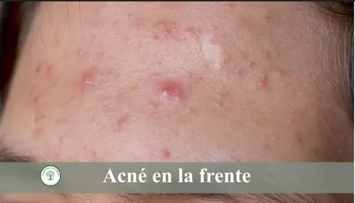 acné en la frente