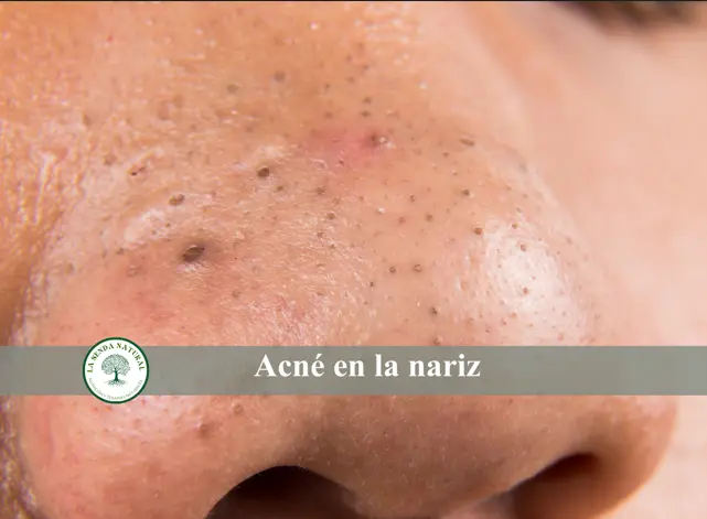 acné en la nariz