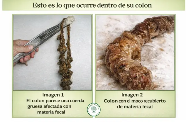 Intestino degradados